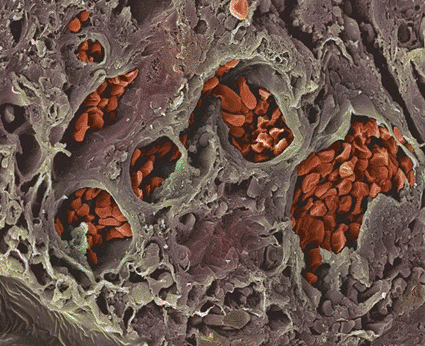 Image: Colored scanning electron micrograph (SEM) of a freeze-fractured section through the colon wall of a patient suffering from colon cancer (Photo courtesy of Steve Gschmeissner / SPL).